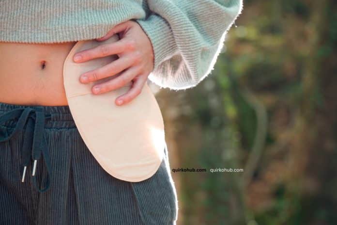 Silver Silicone in Stoma Care: A Smart Barrier for Healing and Protection